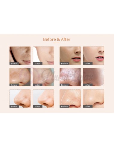 MICRODERMOABRASÃO + PEELING+ JATO DE OXIGENIO | Virtualvantagem | VRT.001.00011