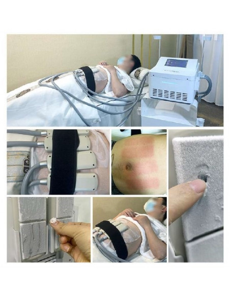 MAQUINA DE CRIOLIPOLISE DE PLACAS + EMS | Virtualvantagem | VRT.001.00070